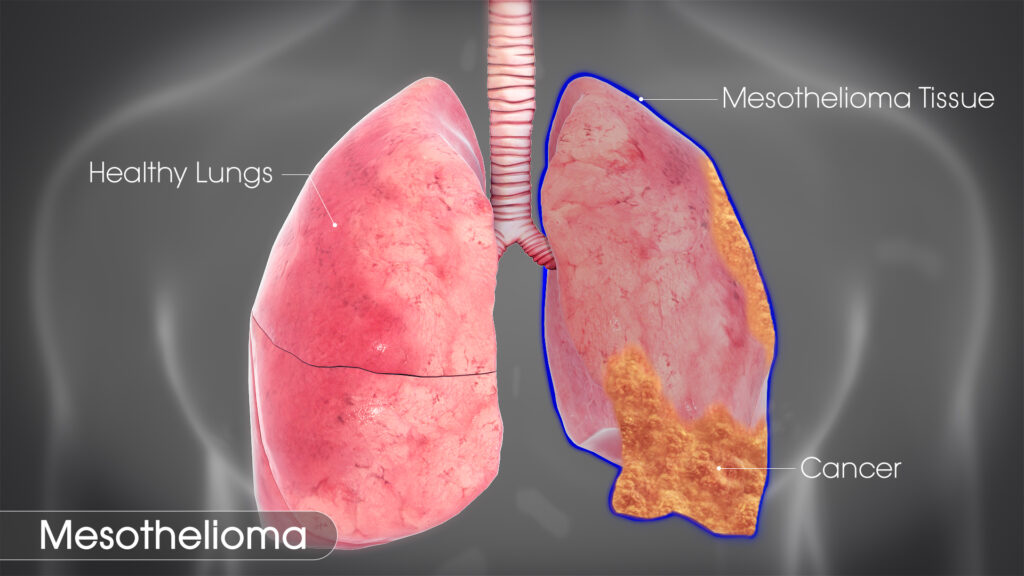More People Must Know About Mesothelioma Cancer