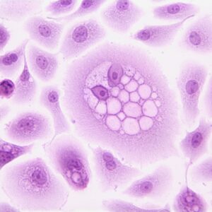 Photo Cancer cells