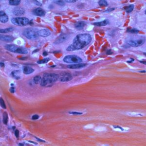 Photo Cancer cells