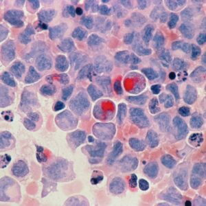 Photo Cancer cells
