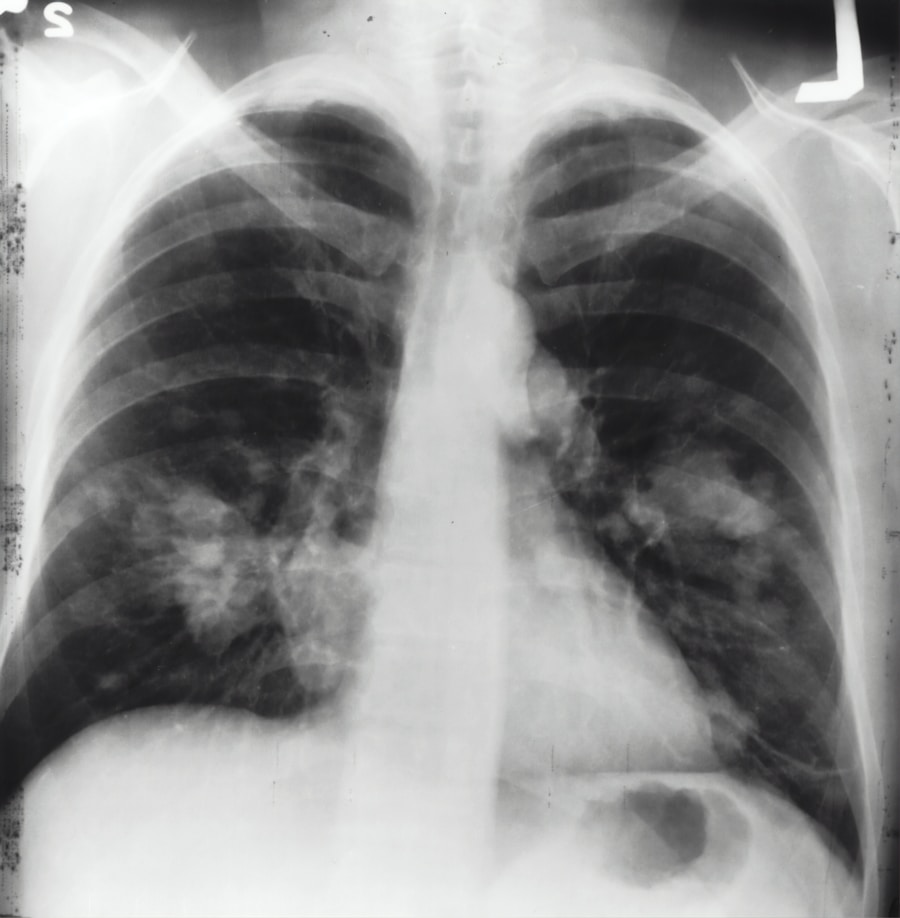 Is Mesothelioma 100% Fatal?