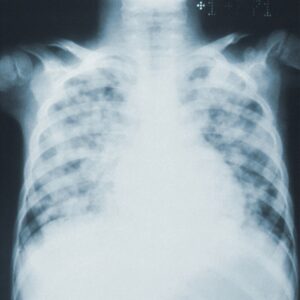 Photo "Is Mesothelioma 100% Fatal?"