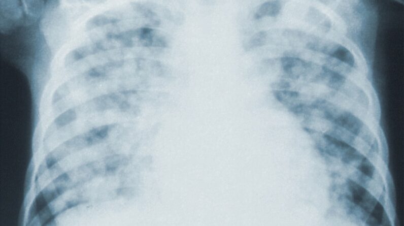 Photo "Is Mesothelioma 100% Fatal?"