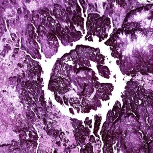 Photo "Does Mesothelioma Spread to the Brain?"