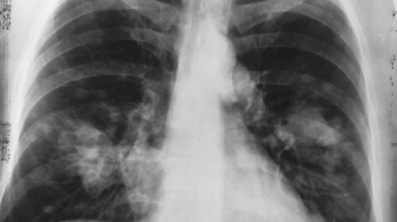 Photo "Mesothelioma Cancer Attorney In Warner Robins Georgia"