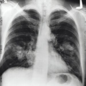 Photo "Mesothelioma Cancer Attorney In Palatine Illinois"